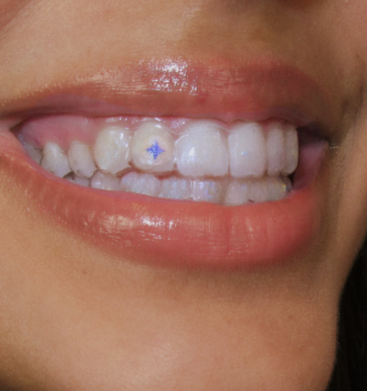 Invisalign™ Style Your Smile Bundle